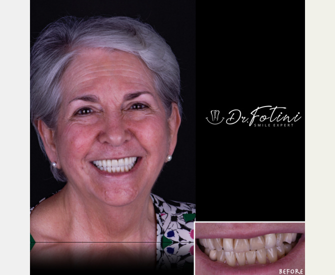 Smile Transformation Before and After by Dr. Fotini in Tysons Corner, VA