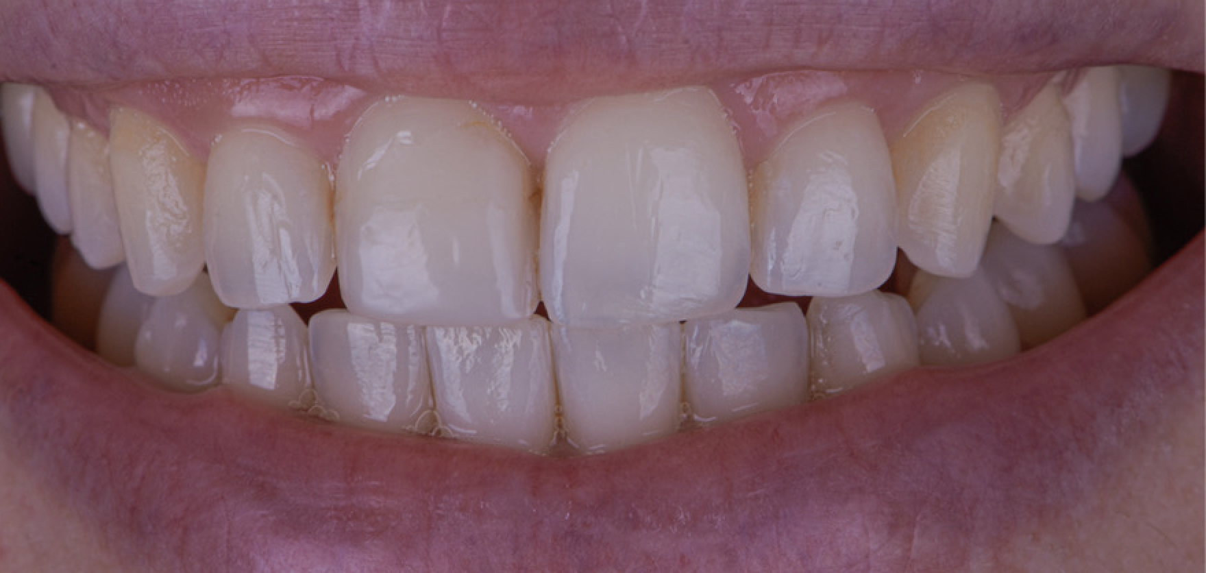 Cosmetic Bonding Teeth Whitening For Central Incisor - Before