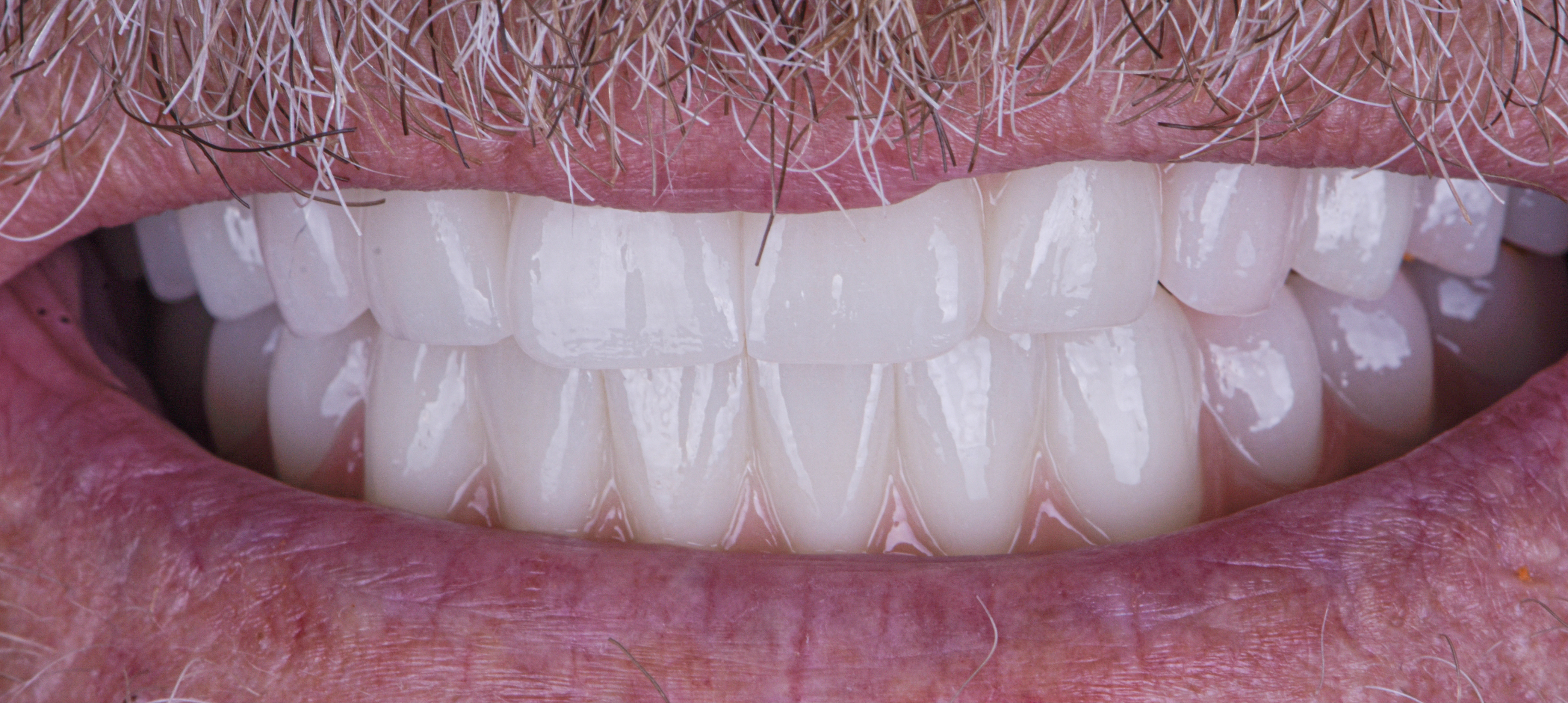 Permanent Implant Supported Porcelain Bridges - After