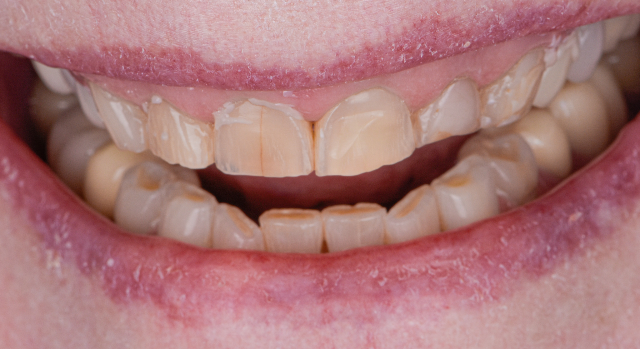 Smile Rejuvenation Porcelain Crowns Gum Recontouring Teeth Whitening Cosmetic Bondings - Before
