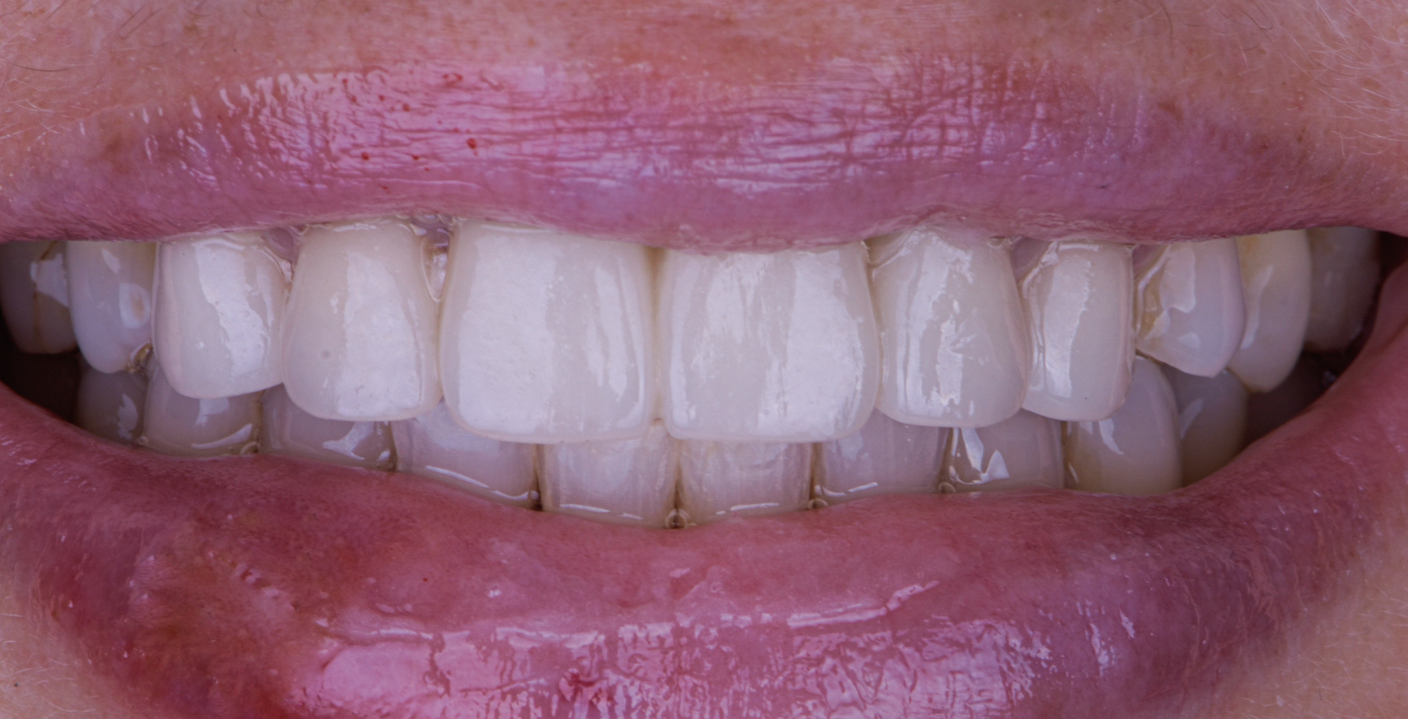 Teeth Supported Porcelain Bridges - After
