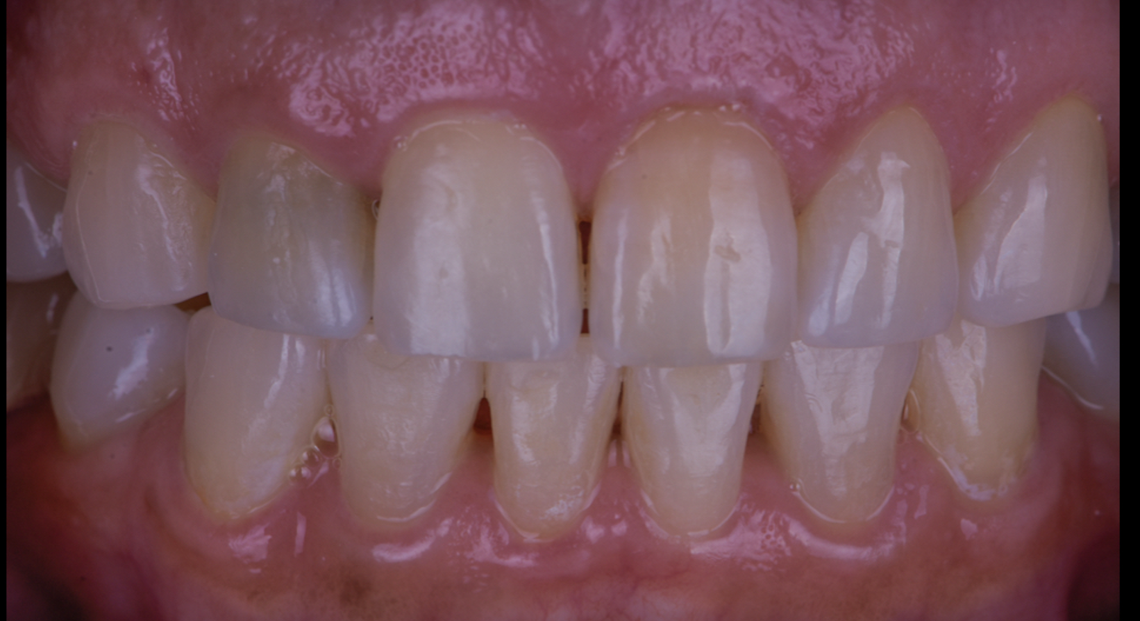 Teeth Whitening - Before
