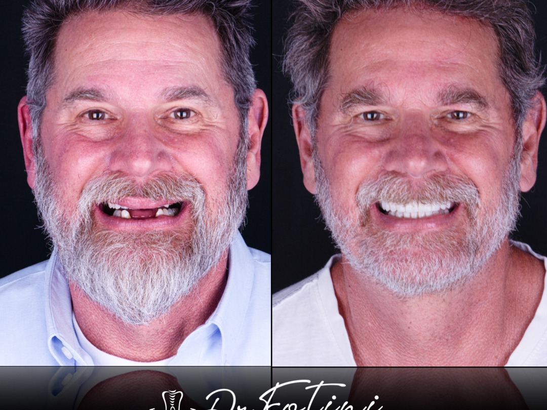 Full Mouth Reconstruction
