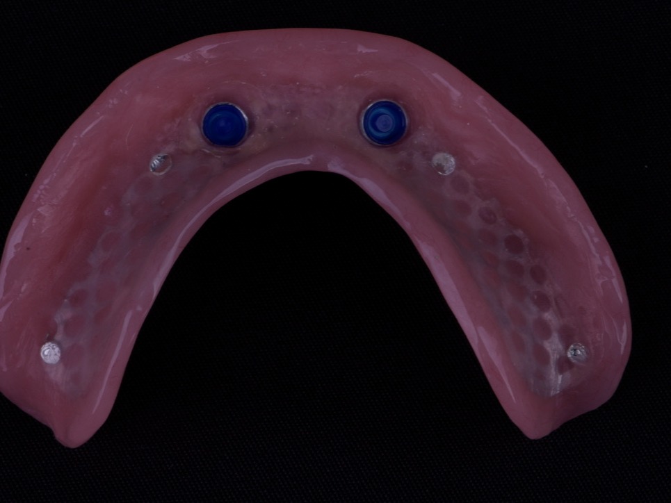 Dentures on Implants