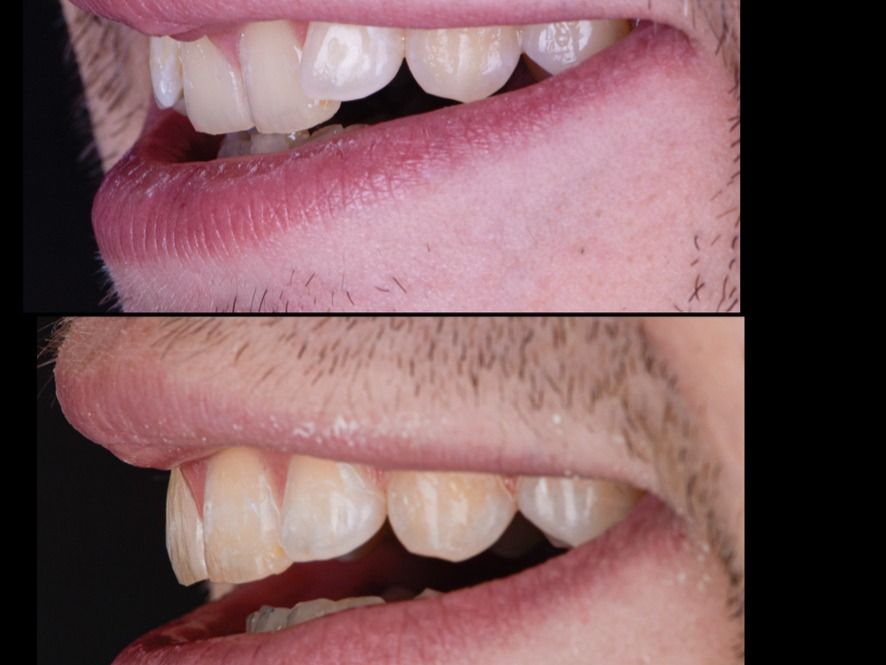 Invisalign