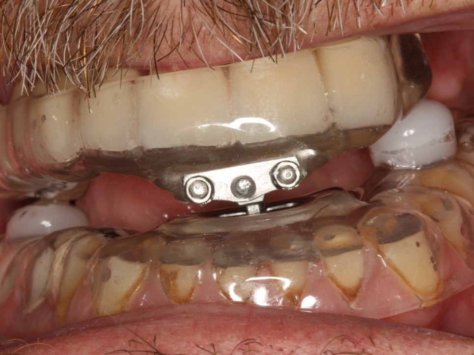 Sleep Apnea Dentistry