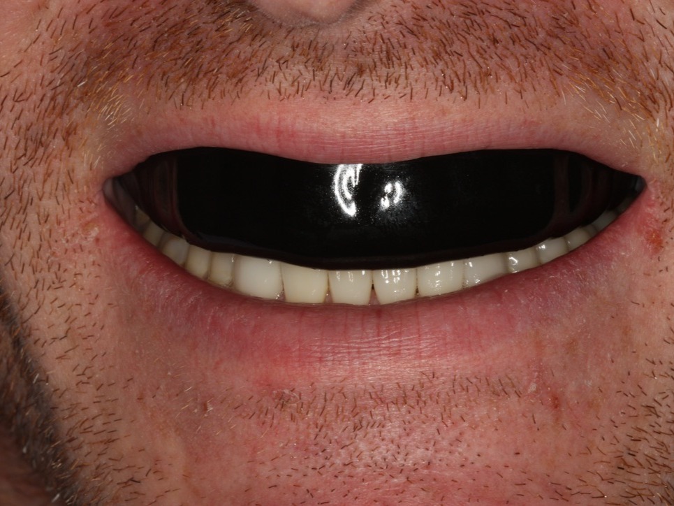Sports Mouthguard
