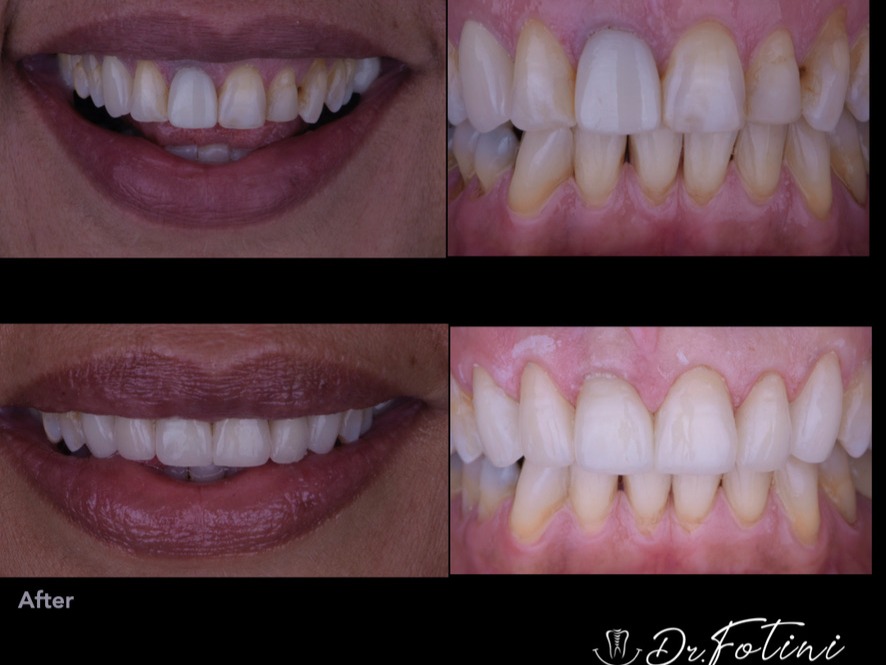 Teeth in a Day