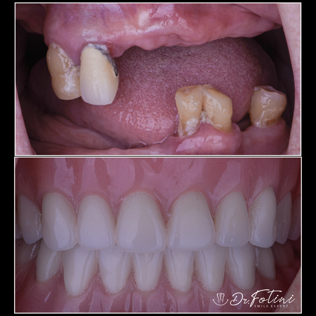 Immediate Dentures