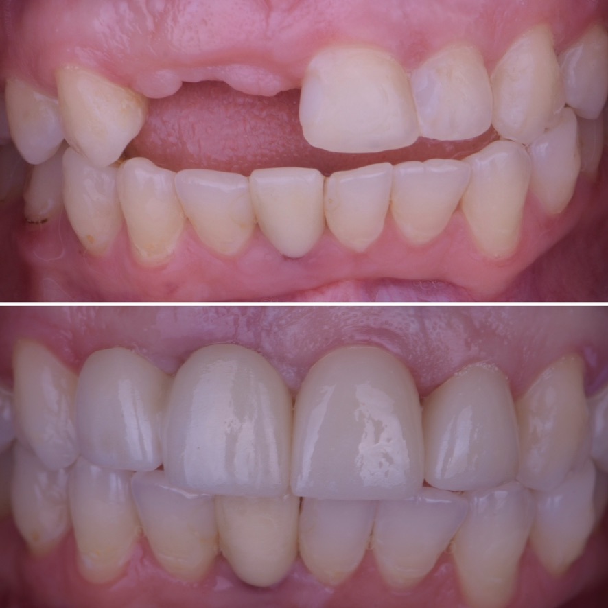 Implant Crowns