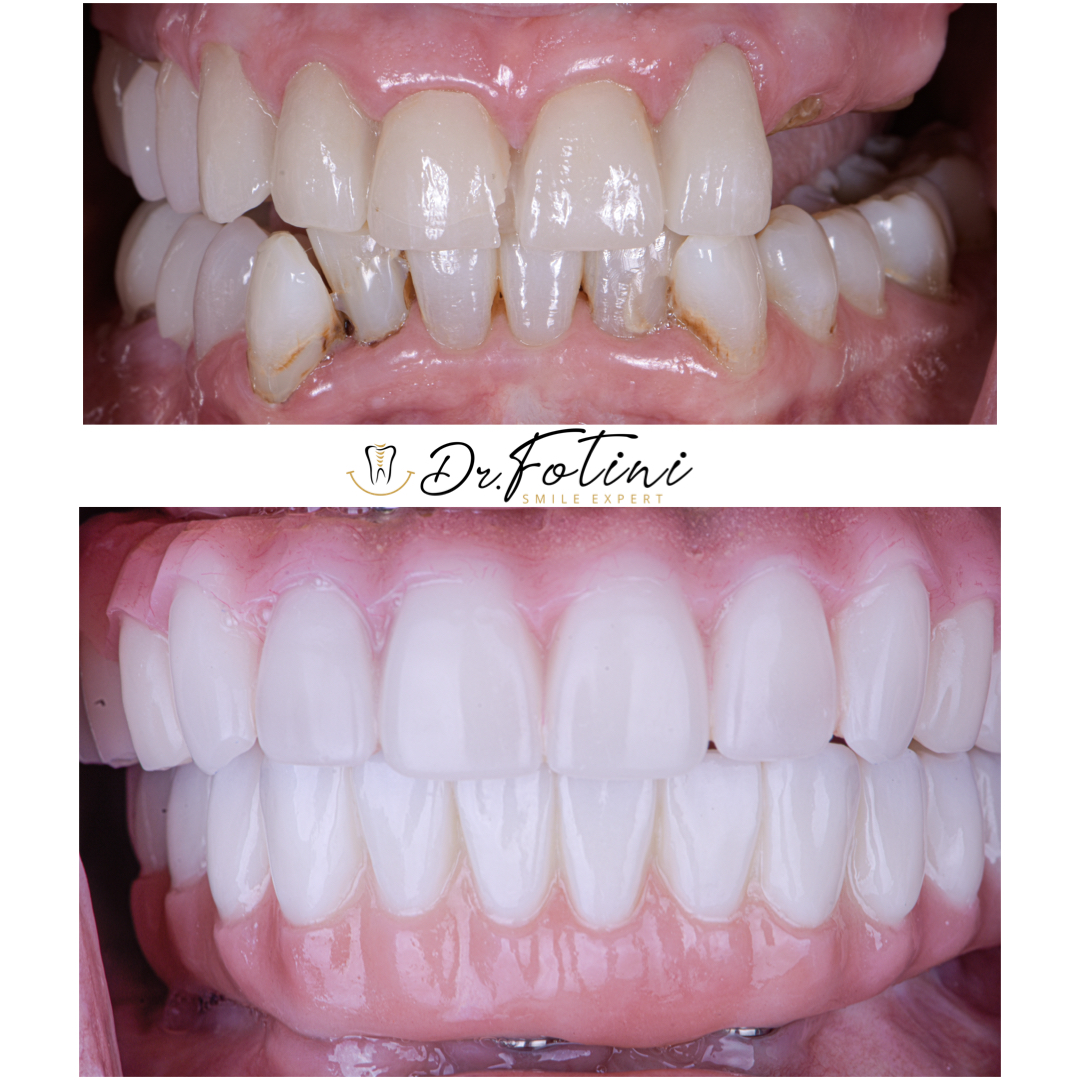 Implant Reconstruction