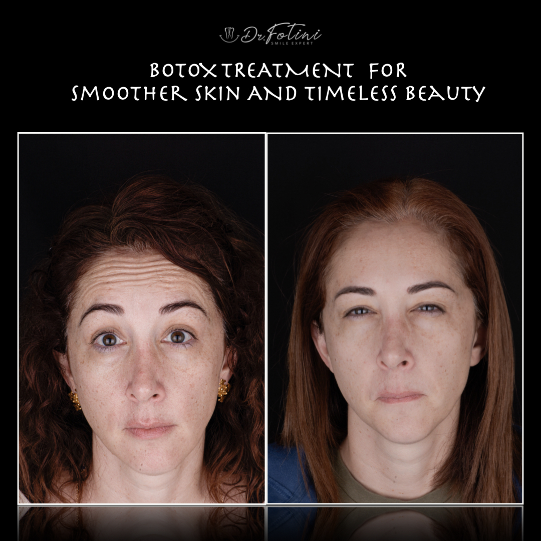 Botox (therapeutic and cosmetic)
