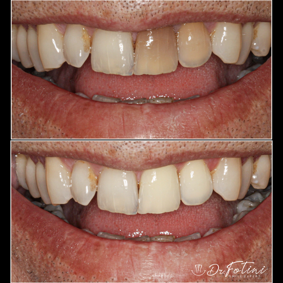 Internal Bleaching