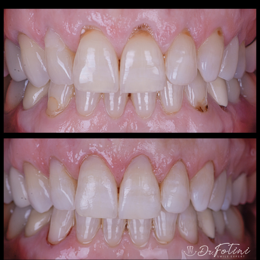 Tooth Colored Fillings
