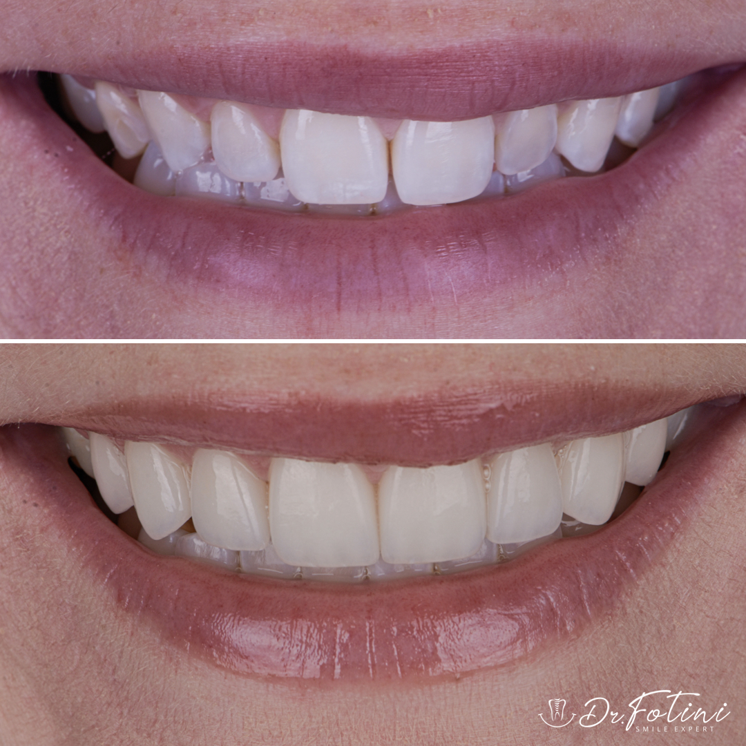 Veneers