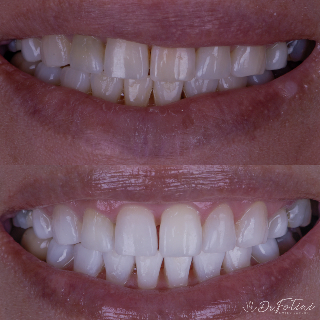Whitening