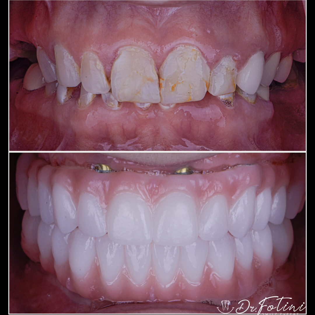 Implant Bridges