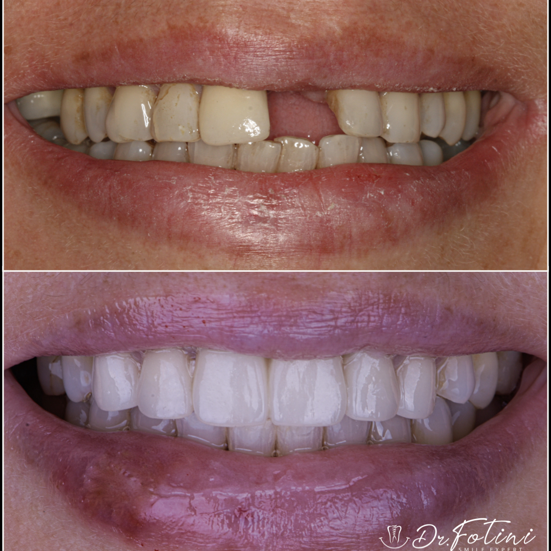 Bridges on Teeth