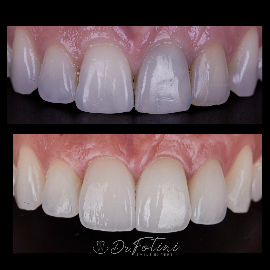 Smile Makeover