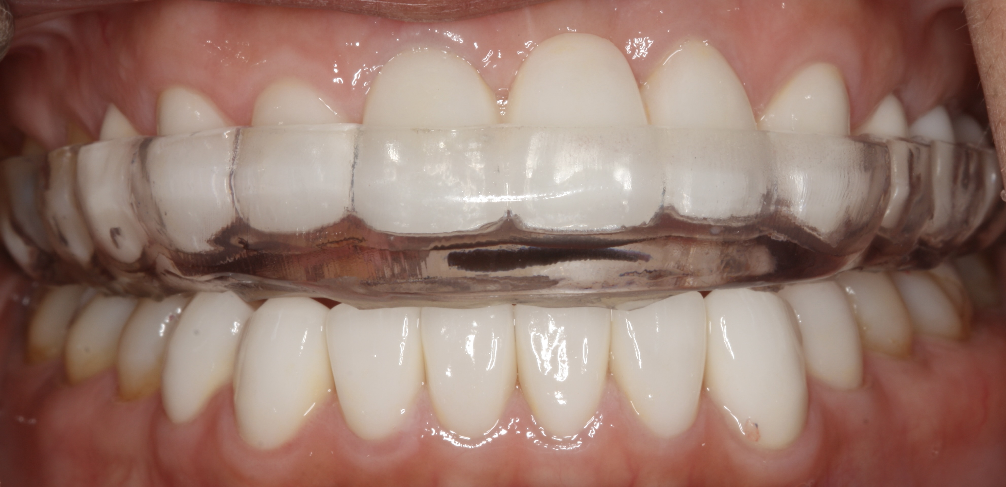TMJ Treatment